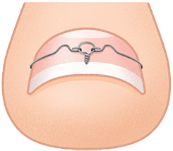 ingrown-nail_img.png